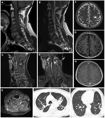 Case Report: A rare case of intramedullary spinal cord abscess with brain abscess caused by Klebsiella pneumoniae underwent surgical intervention